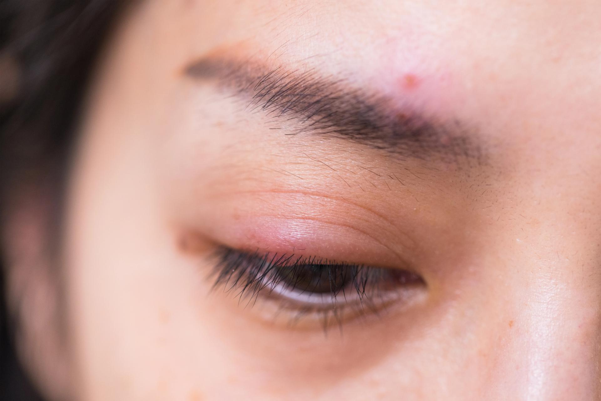 How to Identify and Treat Eye Infections